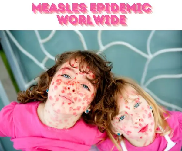 TWO KIDS WITH LIPISTIC MEASLE