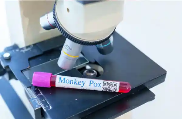 Monkeypox screening