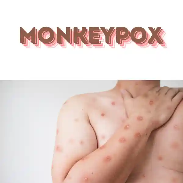 monkey pox